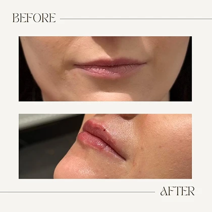 Natural aesthetic treatment results at The Aesthetics Suite Wilmslow