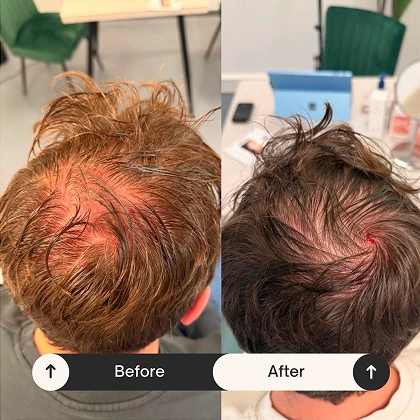PRP hair restoration before and after at The Aesthetics Suite Wilmslow