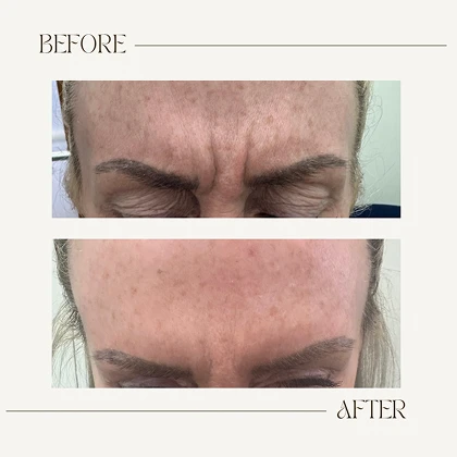 Dermal filler before and after results at The Aesthetics Suite Wilmslow