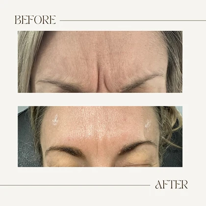 Aesthetic treatment before and after results at The Aesthetics Suite Wilmslow