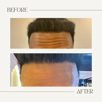Anti-wrinkle treatment before and after at The Aesthetics Suite Wilmslow