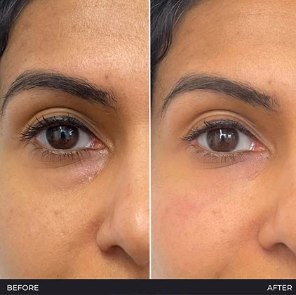 Polynucleotide under eye treatment before and after in Wilmslow