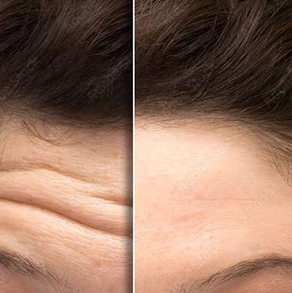 Healthy glowing skin after skin booster treatment in Wilmslow